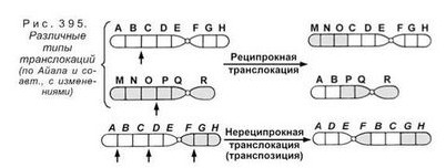 синдрома Дауна