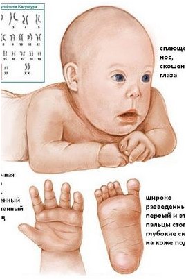 синдром синдром