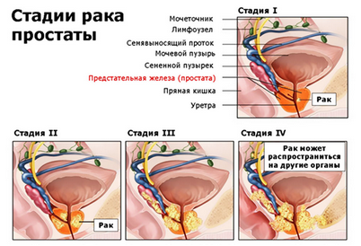 раком простаты