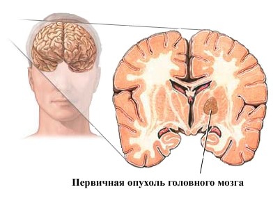 альцгеймера альцгеймера