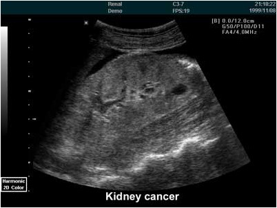 коровья оспа