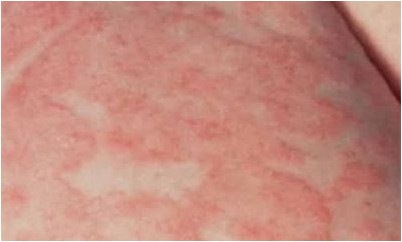 чешуйчатый