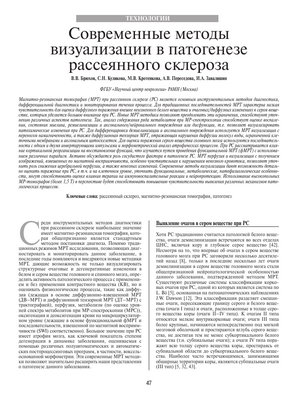 Новый метод визуализации может способствовать раннему выявлению рассеянного склероза
